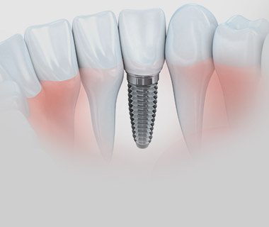 Model of dental implants